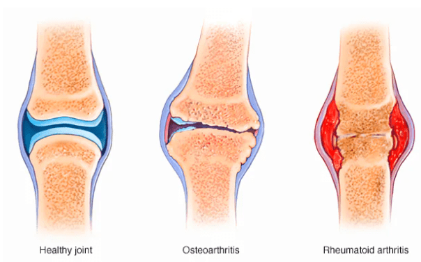 Arthritis Research – Callum @ Hornby High School